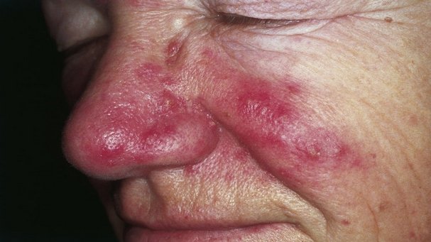 Rosacea Causes, Symptoms and Treatments