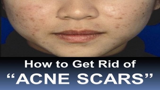 How to Get Rid of Acne Scars Fast How to Get Rid of Acne Scars Fast