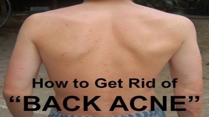 How to Get Rid of Back Acne Fast How to Get Rid of Back Acne Fast